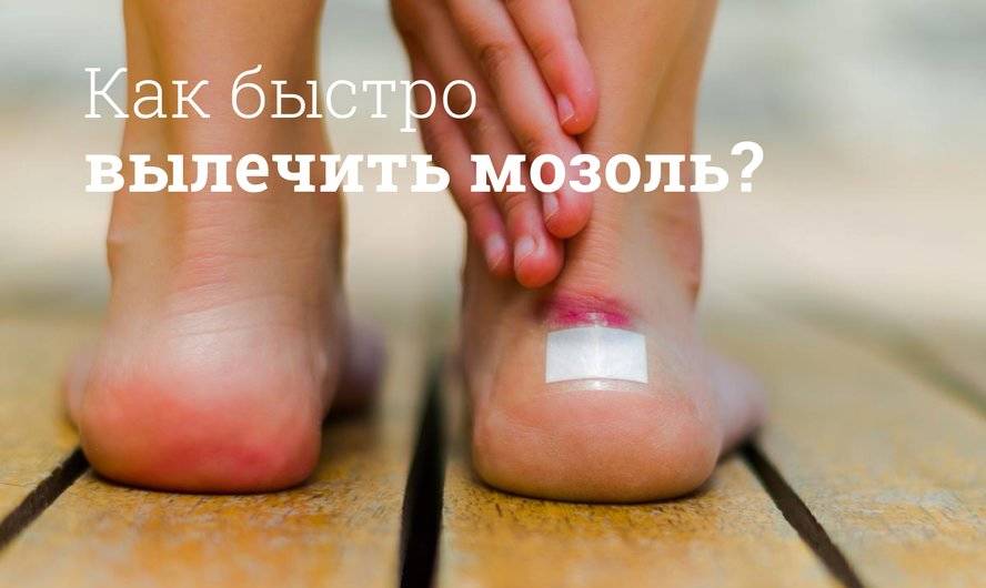 Как вывести сухие мозоли на пальцах ног народными средствами? thumbnail